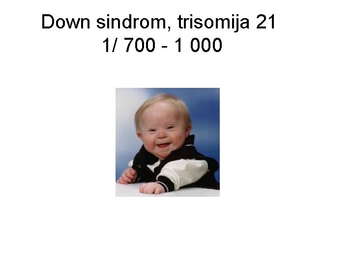 Down sindrom, trisomija 21 1/ 700 - 1 000 