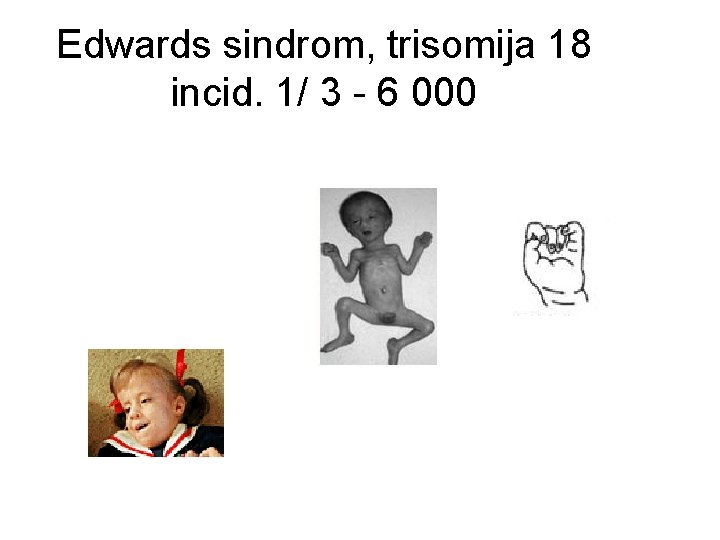 Edwards sindrom, trisomija 18 incid. 1/ 3 - 6 000 