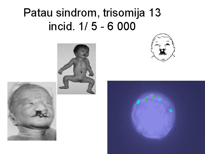 Patau sindrom, trisomija 13 incid. 1/ 5 - 6 000 
