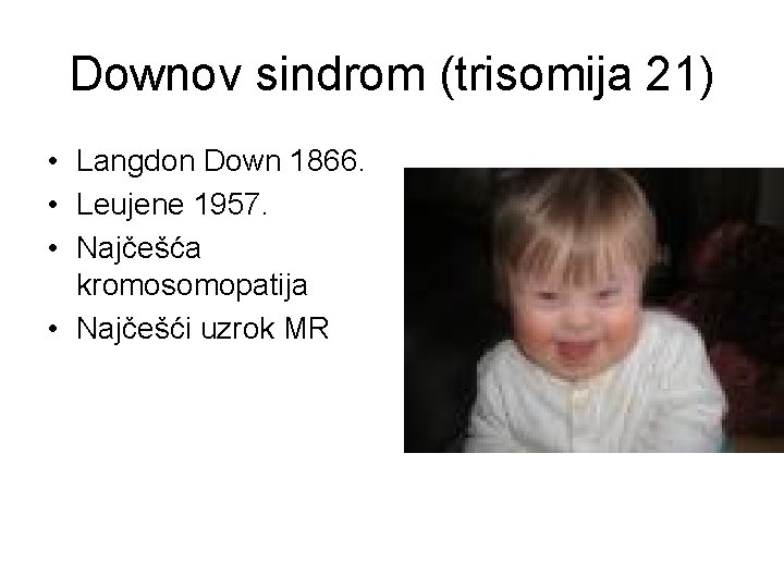 Downov sindrom (trisomija 21) • Langdon Down 1866. • Leujene 1957. • Najčešća kromosomopatija Downov sindrom (trisomija 21) • Langdon Down 1866. • Leujene 1957. • Najčešća kromosomopatija