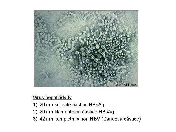 Virus hepatitidy B: 1) 20 nm kulovité částice HBs. Ag 2) 20 nm filamentózní