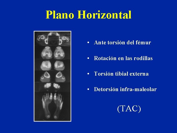 Plano Horizontal • Ante torsión del fémur • Rotación en las rodillas • Torsión