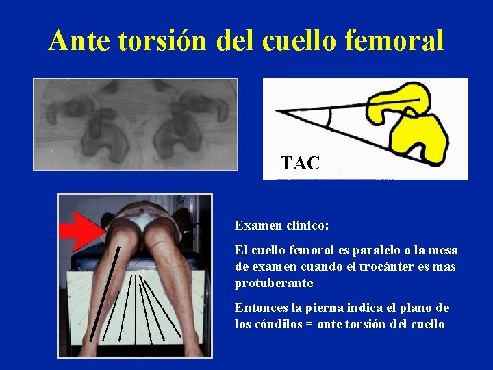 Ante torsión del cuello femoral TAC Examen clínico: El cuello femoral es paralelo a