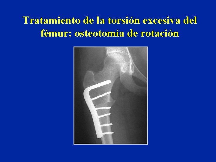 Tratamiento de la torsión excesiva del fémur: osteotomía de rotación 