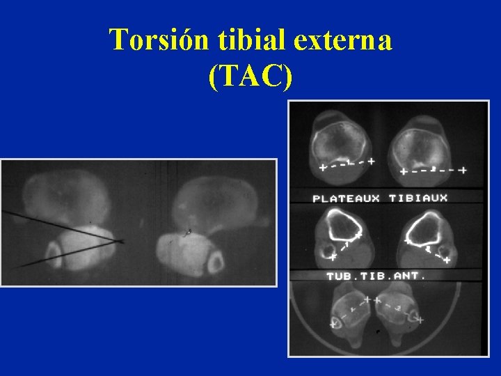 Torsión tibial externa (TAC) 