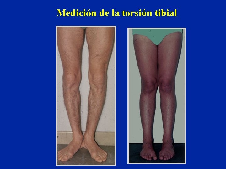 Medición de la torsión tibial 