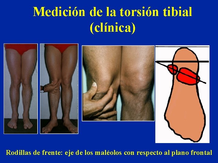 Medición de la torsión tibial (clínica) Rodillas de frente: eje de los maléolos con