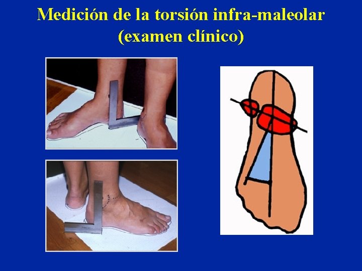 Medición de la torsión infra-maleolar (examen clínico) 