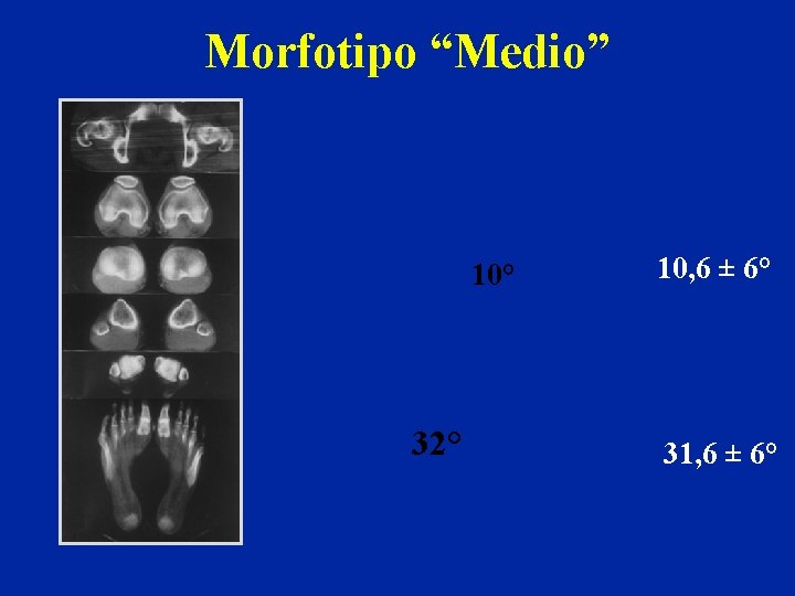 Morfotipo “Medio” 10° 32° 10, 6 ± 6° 31, 6 ± 6° 