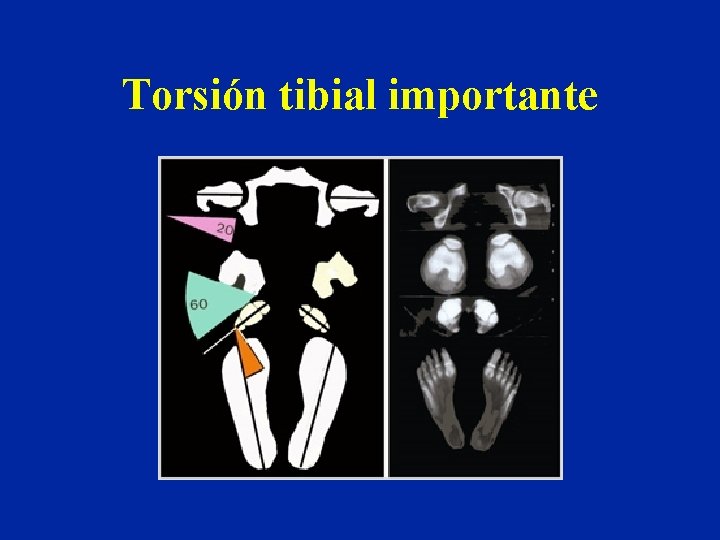 Torsión tibial importante 