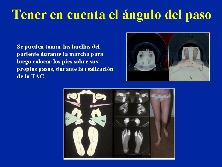 Tener en cuenta el ángulo del paso Se pueden tomar las huellas del paciente