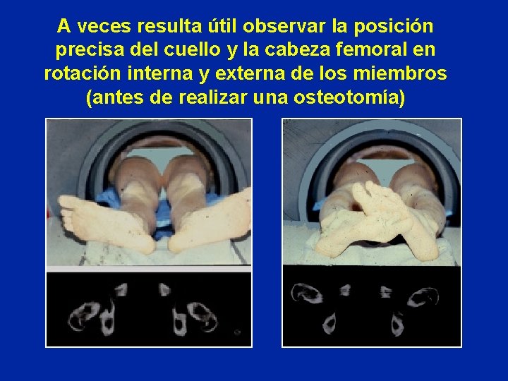 A veces resulta útil observar la posición precisa del cuello y la cabeza femoral