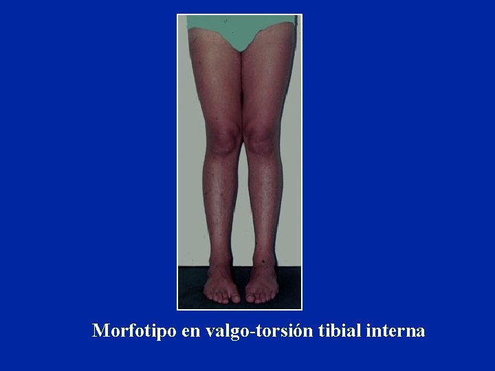 Morfotipo en valgo-torsión tibial interna 