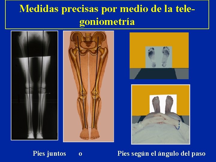 Medidas precisas por medio de la telegoniometría Pies juntos o Pies según el ángulo