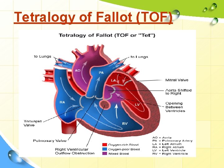 Tetralogy of Fallot (TOF) 