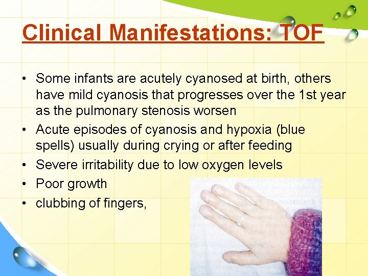 Clinical Manifestations: TOF • Some infants are acutely cyanosed at birth, others have mild