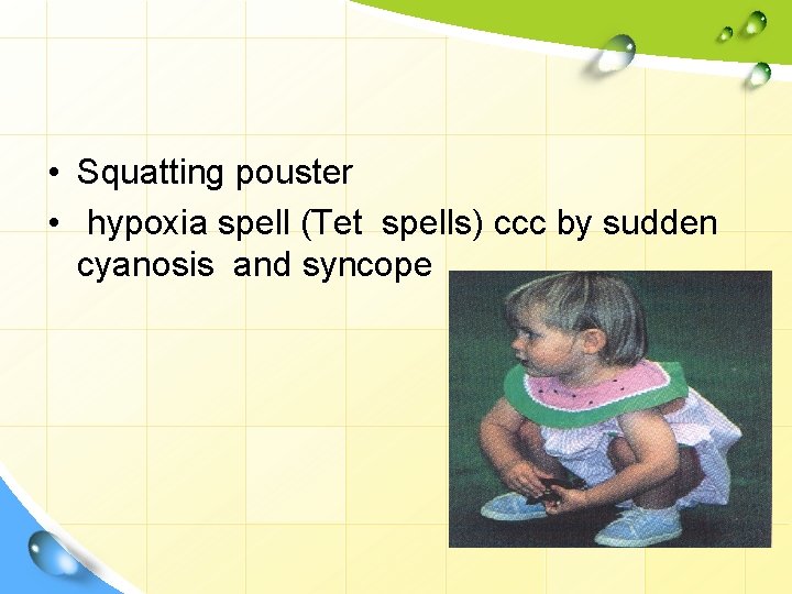  • Squatting pouster • hypoxia spell (Tet spells) ccc by sudden cyanosis and