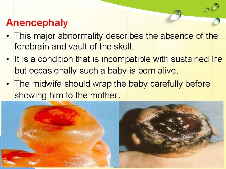 Anencephaly • This major abnormality describes the absence of the forebrain and vault of
