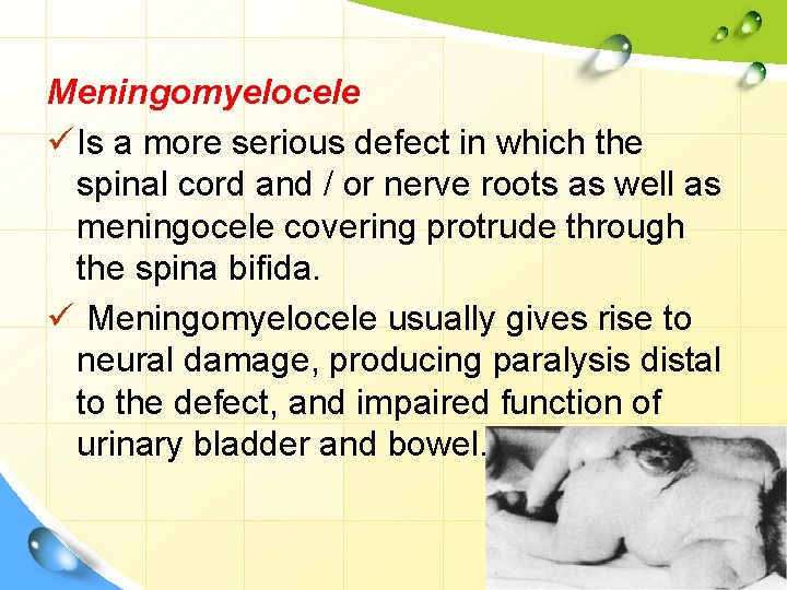 Meningomyelocele ü Is a more serious defect in which the spinal cord and /