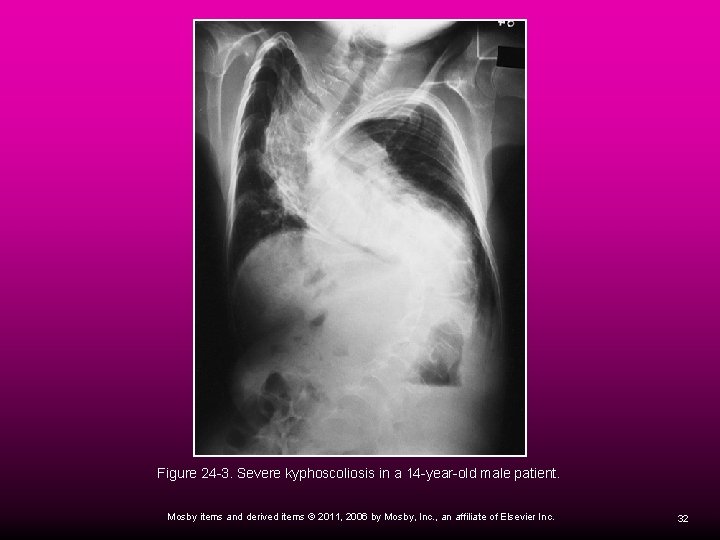 Figure 24 -3. Severe kyphoscoliosis in a 14 -year-old male patient. Mosby items and