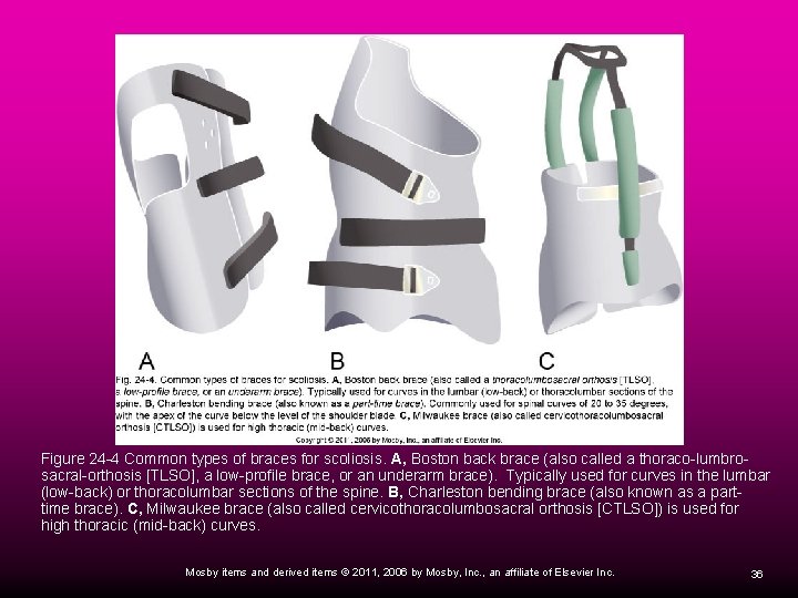 Figure 24 -4 Common types of braces for scoliosis. A, Boston back brace (also