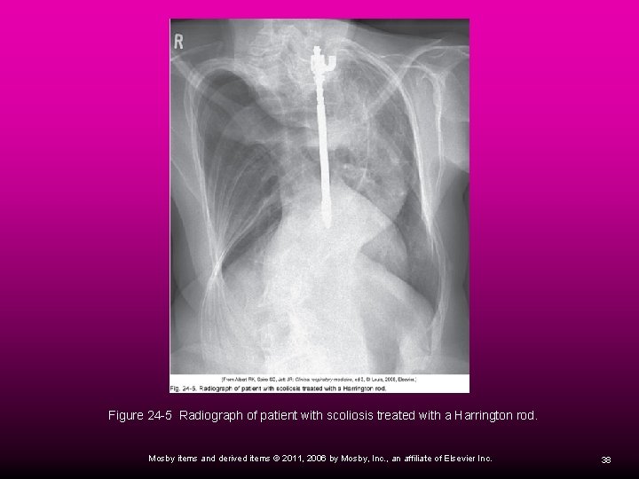 Figure 24 -5 Radiograph of patient with scoliosis treated with a Harrington rod. Mosby