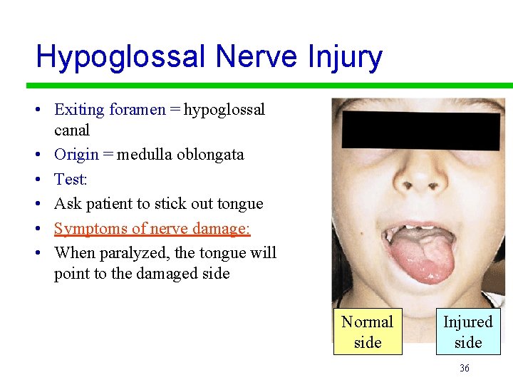 Hypoglossal Nerve Injury • Exiting foramen = hypoglossal canal • Origin = medulla oblongata