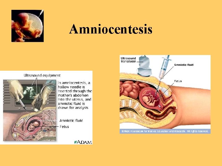 Amniocentesis 