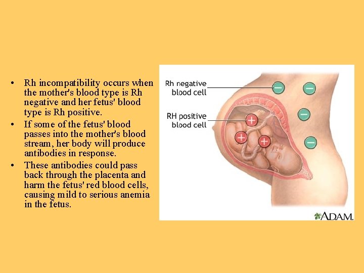  • Rh incompatibility occurs when the mother's blood type is Rh negative and