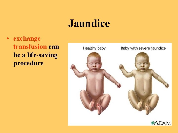 Jaundice • exchange transfusion can be a life-saving procedure 