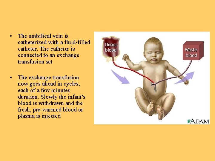  • The umbilical vein is catheterized with a fluid-filled catheter. The catheter is