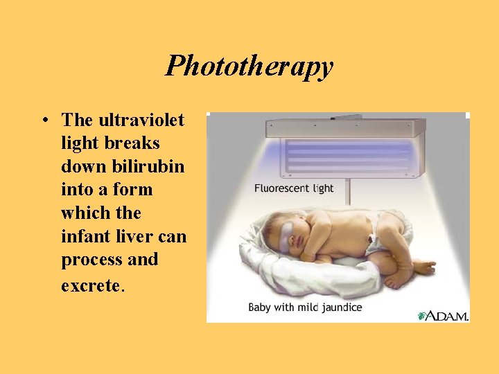 Phototherapy • The ultraviolet light breaks down bilirubin into a form which the infant