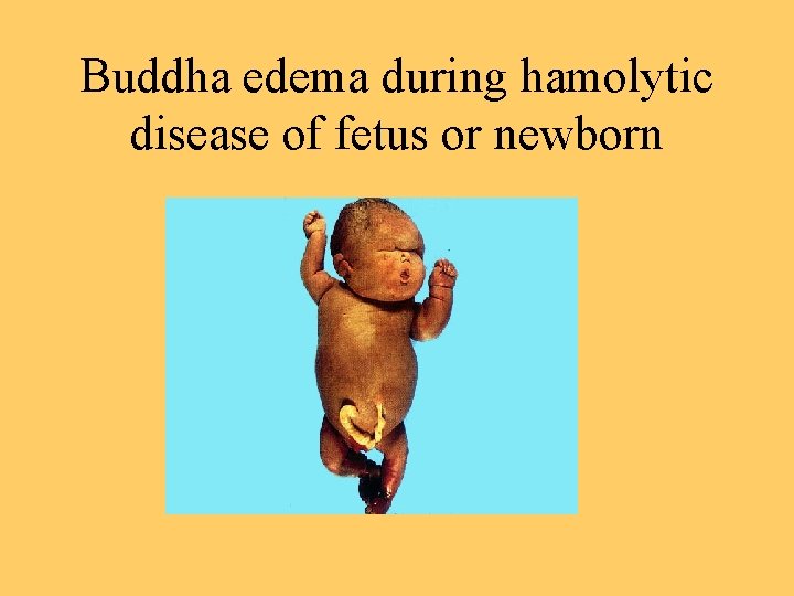 Buddha edema during hamolytic disease of fetus or newborn 