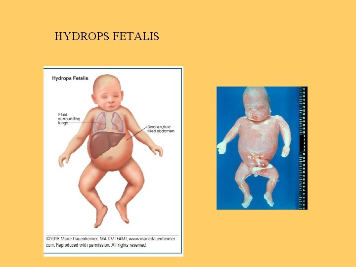 HYDROPS FETALIS 