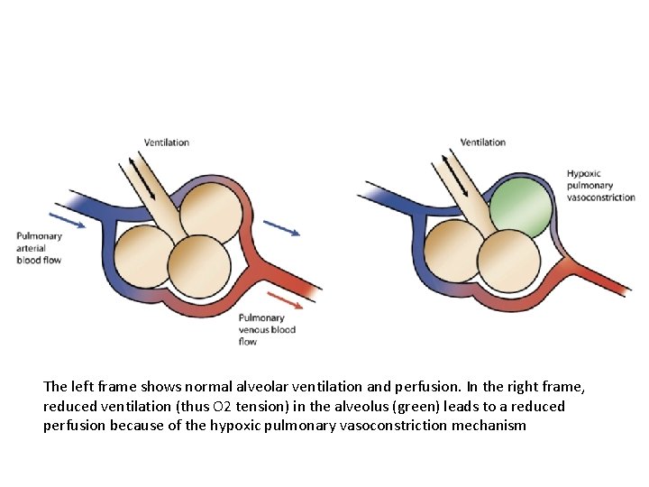 The left frame shows normal alveolar ventilation and perfusion. In the right frame, reduced