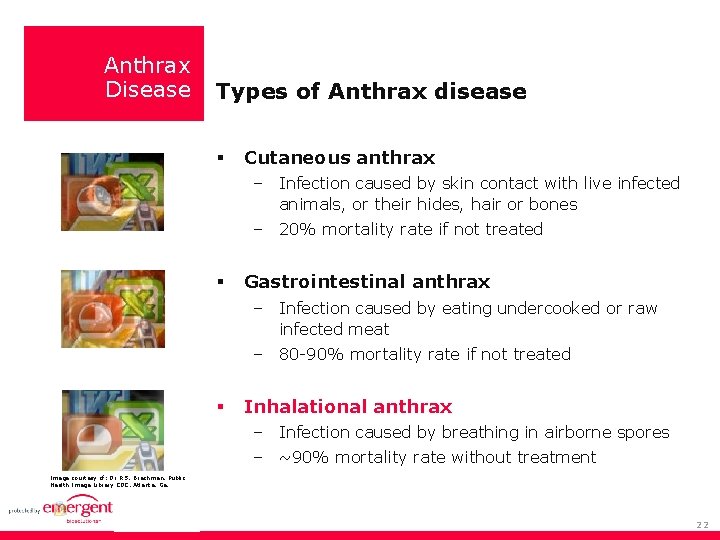 Anthrax Disease Types of Anthrax disease Cutaneous anthrax – Infection caused by skin contact