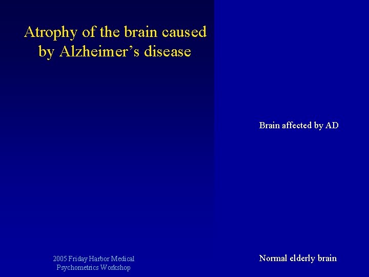 Atrophy of the brain caused by Alzheimer’s disease Brain affected by AD 2005 Friday