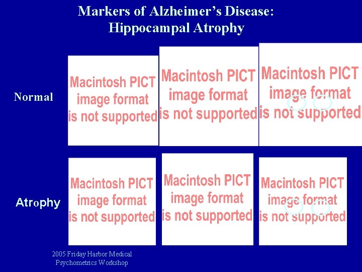 Markers of Alzheimer’s Disease: Hippocampal Atrophy Normal Atrophy 2005 Friday Harbor Medical Psychometrics Workshop