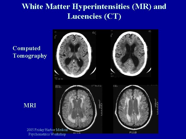 White Matter Hyperintensities (MR) and Lucencies (CT) Computed Tomography MRI 2005 Friday Harbor Medical