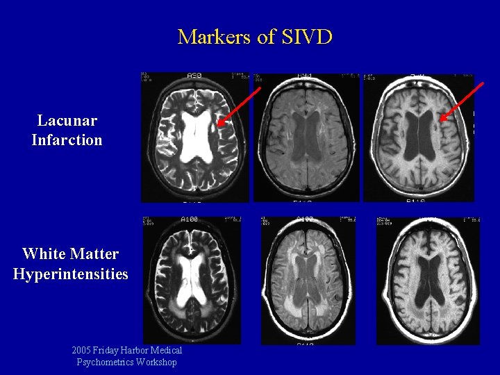 Markers of SIVD Lacunar Infarction White Matter Hyperintensities 2005 Friday Harbor Medical Psychometrics Workshop
