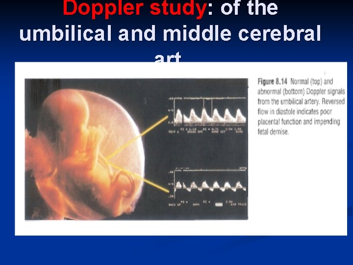 Doppler study: of the umbilical and middle cerebral art. 
