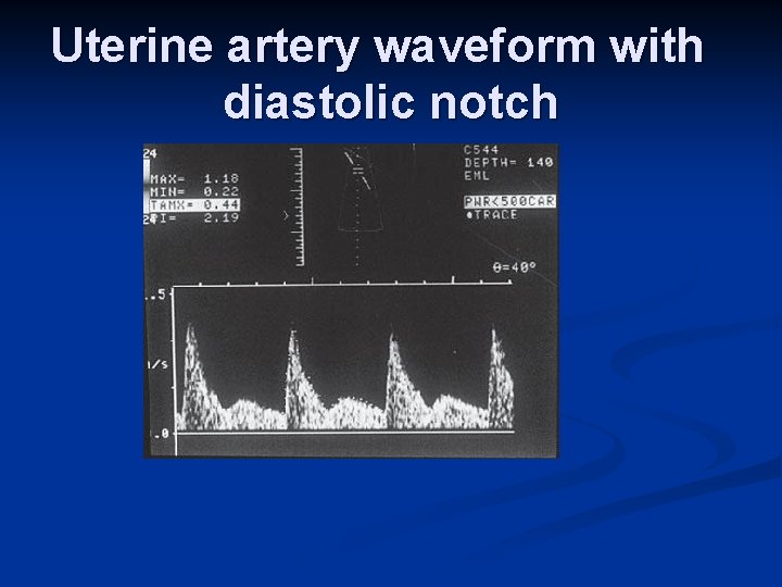 Uterine artery waveform with diastolic notch 