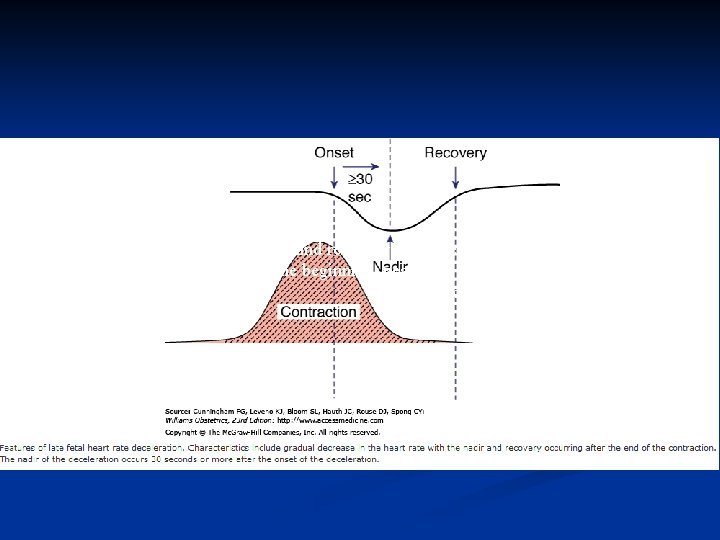 Onset, nadir, and recovery of the deceleration occur after the beginning, peak, and end
