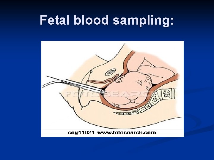 Fetal blood sampling: 