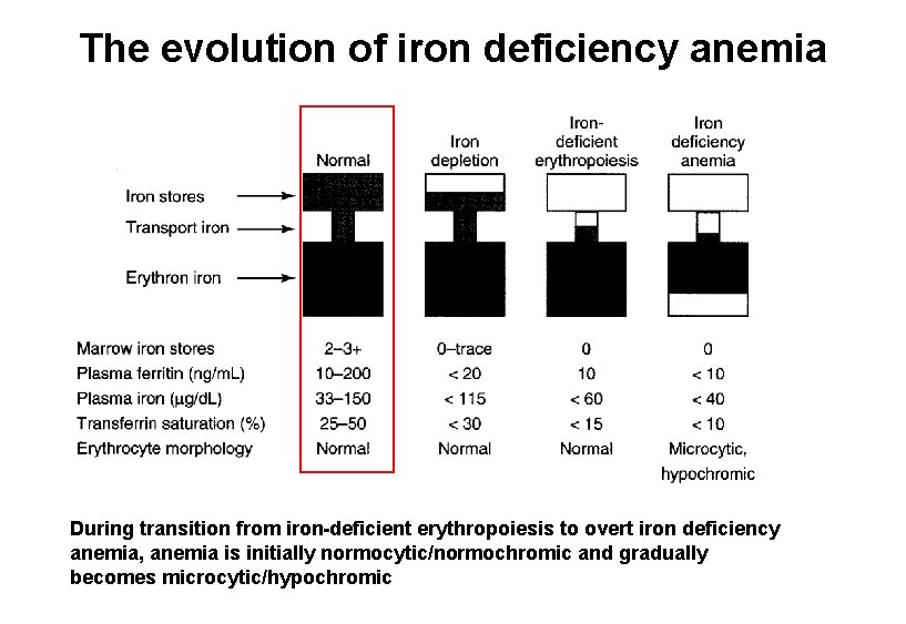 The evolution of iron deficiency anemia During transition from iron-deficient erythropoiesis to overt iron