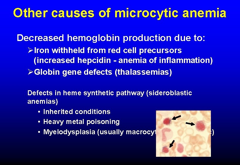 Other causes of microcytic anemia Decreased hemoglobin production due to: ØIron withheld from red