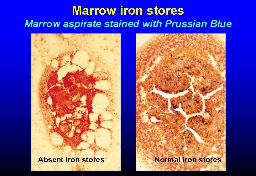 Marrow iron stores Marrow aspirate stained with Prussian Blue Absent iron stores Normal iron