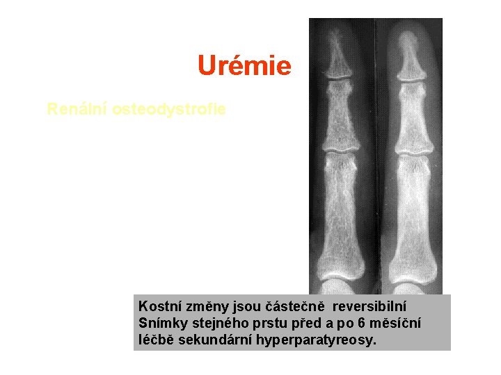Urémie Renální osteodystrofie Kostní změny jsou částečně reversibilní Snímky stejného prstu před a po
