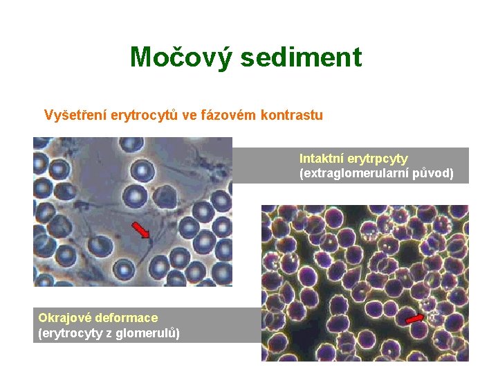 Močový sediment Vyšetření erytrocytů ve fázovém kontrastu Intaktní erytrpcyty (extraglomerularní původ) Okrajové deformace (erytrocyty