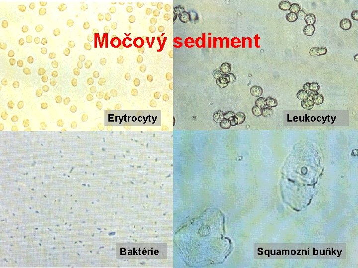 Močový sediment Erytrocyty Baktérie Leukocyty Squamozní buňky 